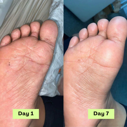 Stayfoll® AntiFungal Relief Soap Bar