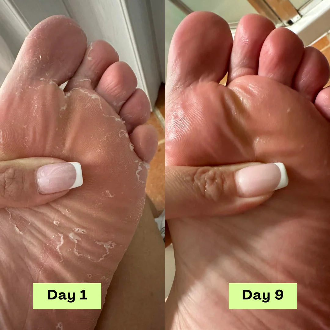 Stayfoll® AntiFungal Relief Soap Bar